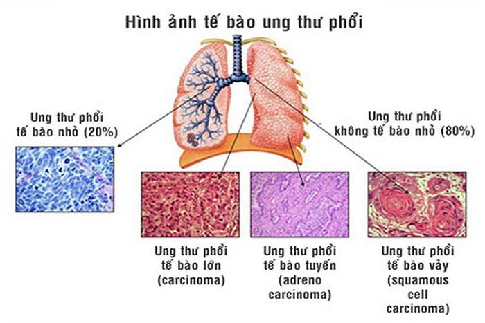 ung thư phổi nguyên phát phân làm 4 loại:ung thư biểu mô tế bào vảy, ung thư biểu mô tuyến, ung thư biểu mô tế bào lớn, ung thư biểu mô tế bào nhỏ