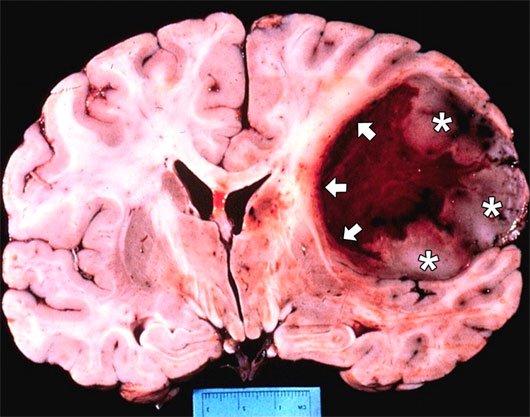 Các loại khối u não