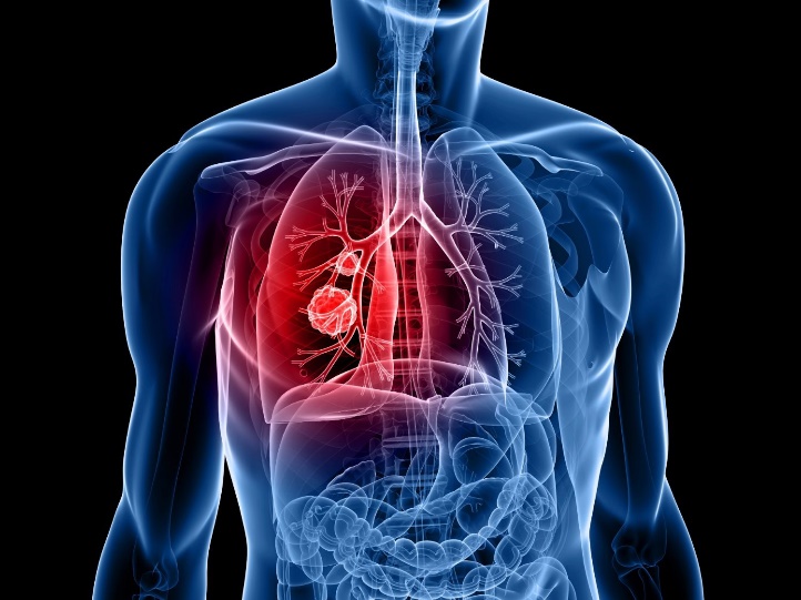 dấu hiệu ung thử phổi