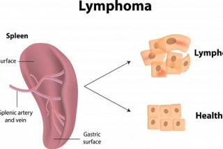 lymphoma di căn