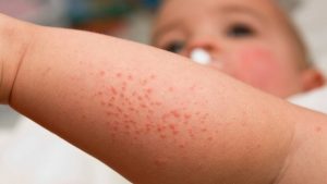 Khi nào sốt, chảy máu mũi ở trẻ là dấu hiệu cảnh báo nguy cơ mắc ung thư máu 